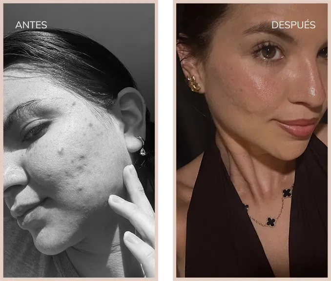 Antes y despues acné